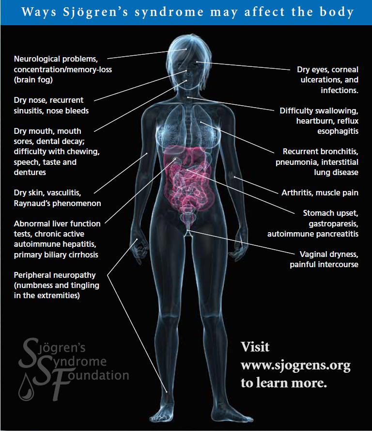 Symptoms Of Sjogren S   Sjogrens Body Poster 2014 