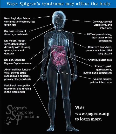 Symptoms Of Sjogrens
